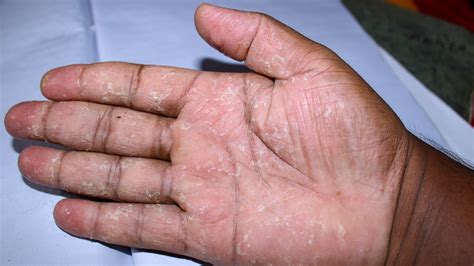 Palmar and Plantar Psoriasis: Diagnosis, Treatment, and More