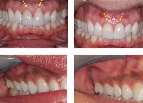 Laser Gum Treatment – Morgan & Lemke Periodontics & Dental Implants