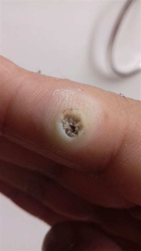 Someone on r/peeling told me that my finger wrat on a salicylic acid ...