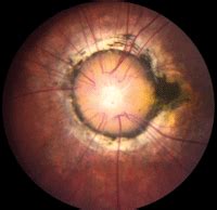 Choroidal Crescent Optic Nerve