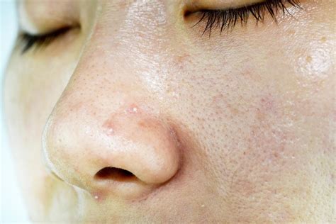 Oily skin: 6 treatments, causes, and prevention