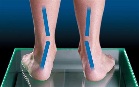 5 Easy Steps For Flat Feet Overpronation Treatment | by shape crunch | Medium