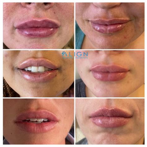 How Soon After Lip Injections Can You Get More? - GA Fashion