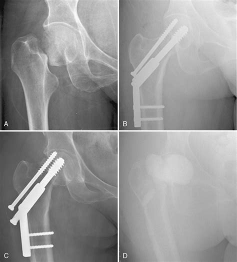 Femoral Neck Fracture Treatment