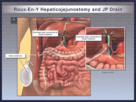 Roux-En-Y Hepaticojejunostomy and JP Drain - TrialQuest Inc.