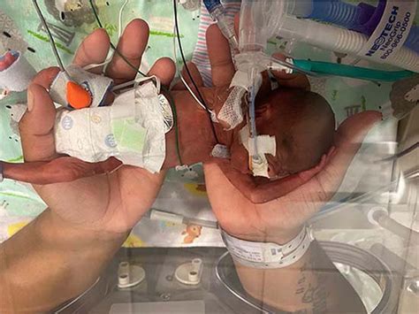 Curtis Means, Alabama boy weighing less than a pound at birth, is world’s most premature ...