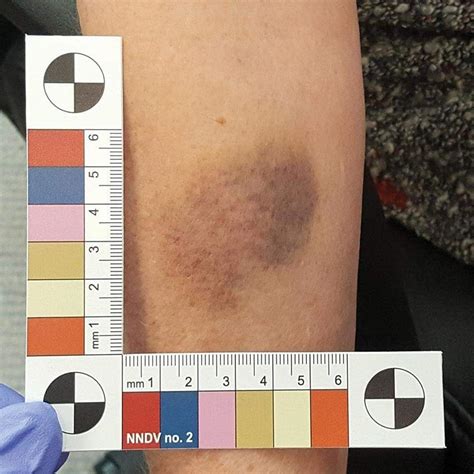 Equimosis Y Hematoma