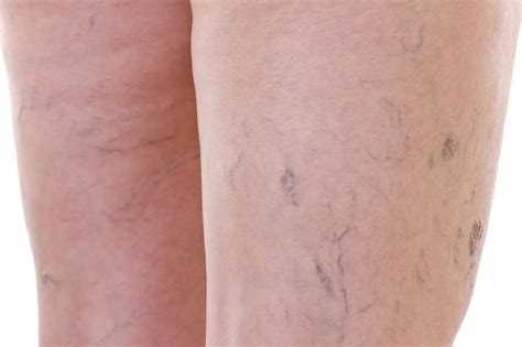 Symptoms of Thread Veins - Cincinnati OH - RejuVeination