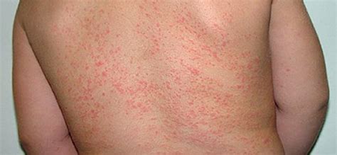 Prickly Heat Symptoms, Causes, Prognosis, Treatment | Prickly Heat ...