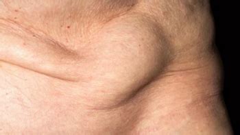 What is Inguinal Hernia? Causes, Surgery, Recovery