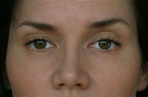 What Is Ptosis And How Is It Caused?