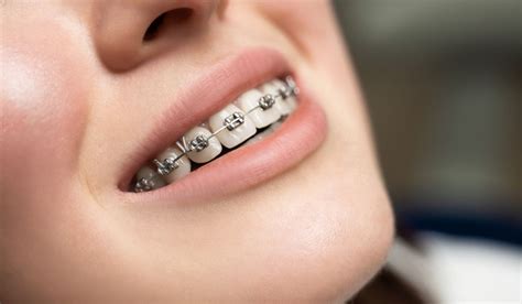 Sensitive Teeth With Braces: How To Manage The Pain - CavitiesGetAround