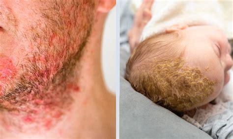 Pityrosporum Folliculitis Scalp