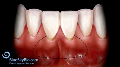 Patient Treatment Videos: Free Gingival Graft - YouTube