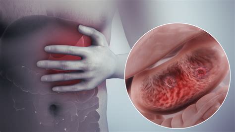 Various reasons for Stomach Ulcer - Scientific Animations