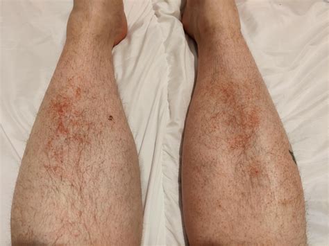 Itchy hot rash on both shins? : r/DermatologyQuestions