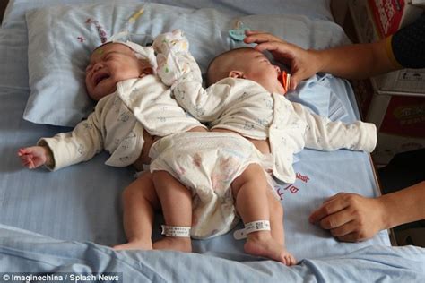 Chinese conjoined twins separated in operation using 3D printing technology | Daily Mail Online