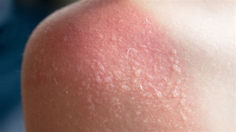 If You Get Sunburn Blisters, Here's What You Should Do