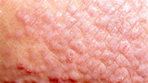 Types of Eczema: Contact Dermatitis | Gladskin