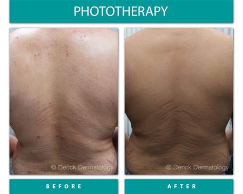 Before & After Gallery - Phototherapy (NBUVB) - Derick Dermatology