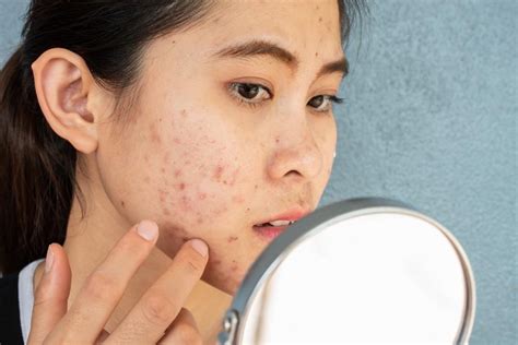 5 Reasons Why You Shouldn't Pick at Your Acne: Specialists In Dermatology: