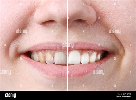 whitening or bleaching treatment ,before and after ,woman teeth and smile, close up, isolated on ...