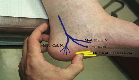 Baxter’s Nerve Entrapment... Healing those painful heels - Almawi Limited The Podiatry Clinic