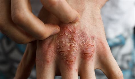 Eczema Causes, Symptoms, Treatments How To Get Rid Of Eczema | lupon.gov.ph