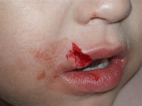 Lips Bleeding After Waking Up at Stephine Poulos blog