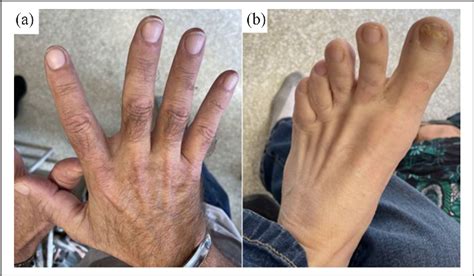 Successful treatment of acrodermatitis continua of Hallopeau with tildrakizumab: A case report ...