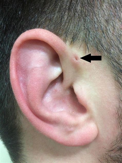 Cureus | Preauricular Sinus: A Tale of Forgetful Rediscovery