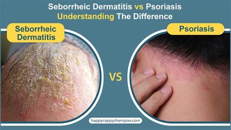 Seborrheic Dermatitis vs Psoriasis: Understanding The Difference