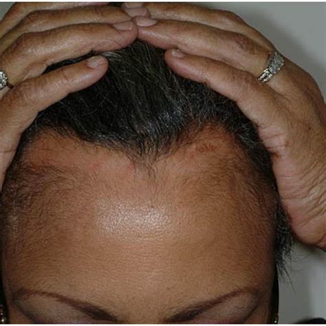 in frontal fibrosing alopecia presentation at the time of diagnosis in... | Download Scientific ...