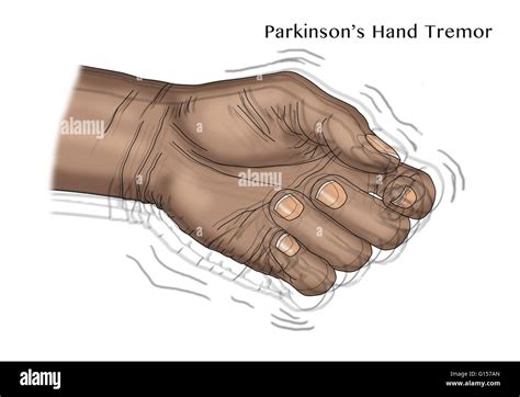 Illustration of a hand tremor, one of the symptoms of Parkinson's disease Stock Photo - Alamy
