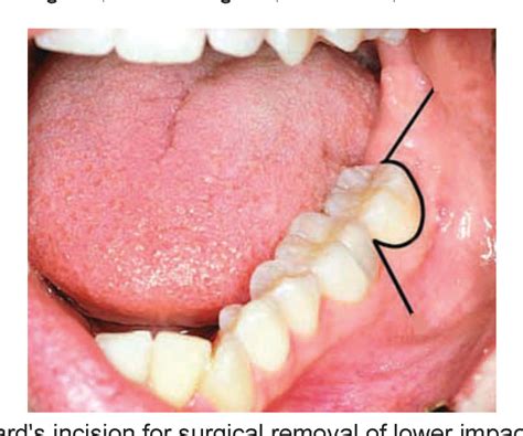 [PDF] Lingual nerve injury following surgical removal of mandibular ...