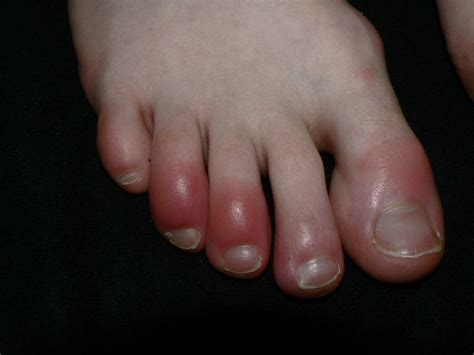 Winter Chilblains | Northwest Foot Care | Bend Oregon Podiatrists : Northwest Foot Care