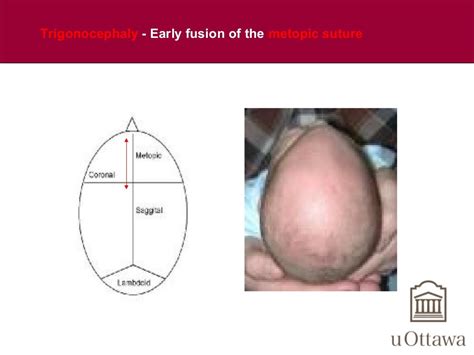 Craniofacial anomalies