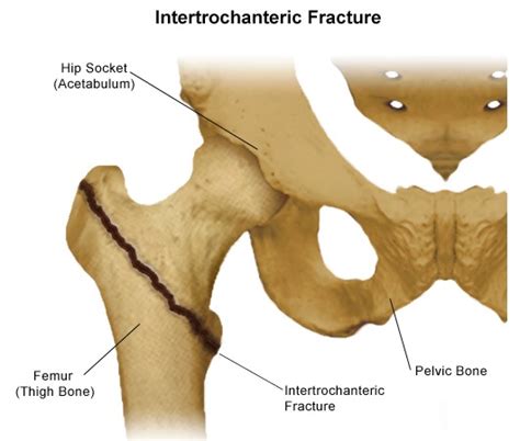 Hip Fracture