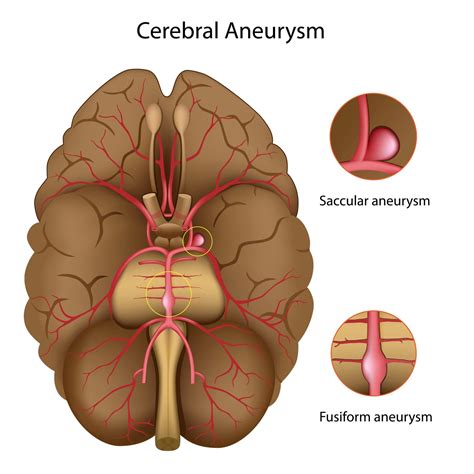 What You Need to Know About Brain Aneurysms - Premier Neurology & Wellness Center