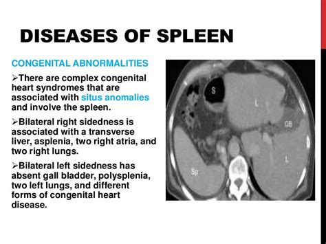 Diseases of spleen