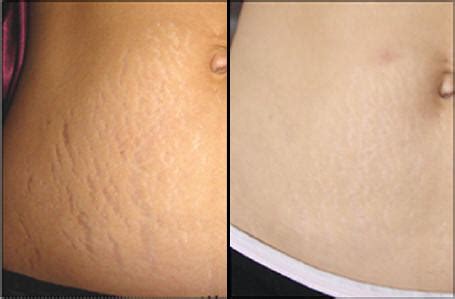 Stretch Marks: Removal Of Stretch Marks Cure