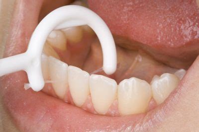 歯石除去 歯石 溶かす 歯磨き粉 426386