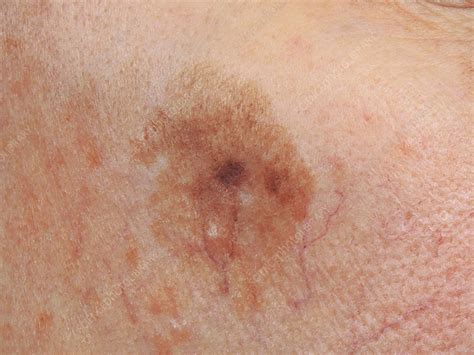 Lentigo maligna melanoma - Stock Image - C046/1646 - Science Photo Library