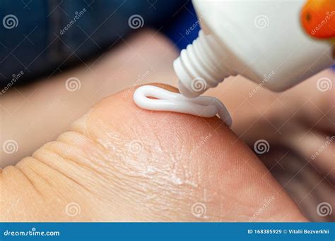 Applying Cream from the Tube on the Feet Sole for the Treatment of Corn, Callus, Callosity ...