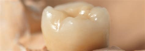 Zirconium prosthesis for implantology: advantages | Sanident