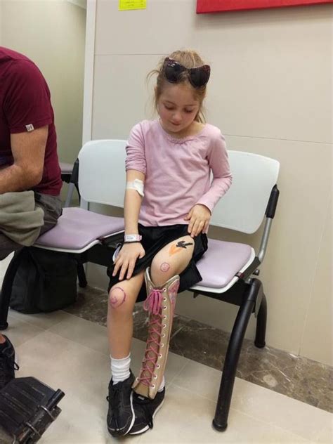 Girl who faced having her leg amputated has pioneering op to lengthen her leg - WSBuzz.com