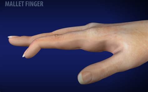 What Is A Mallet Finger? - Virtual Hand Care