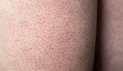 Keratosis Pilaris | Dermatologist Philadelphia | Dermatology Practice Main Line PA - Ringpfeil ...