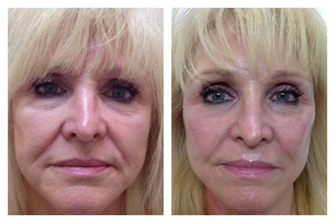 Liquid Facelift | Liquid facelift, Neck lift, Facelift before and after