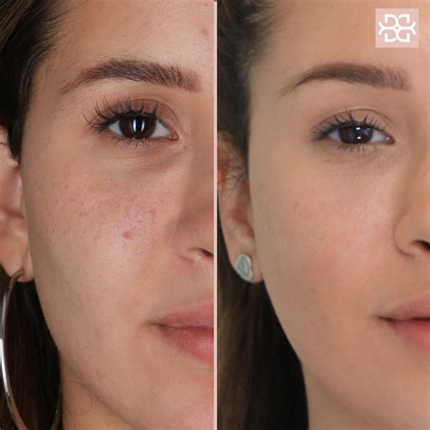 Acne Scars Before And After Laser | Before And After